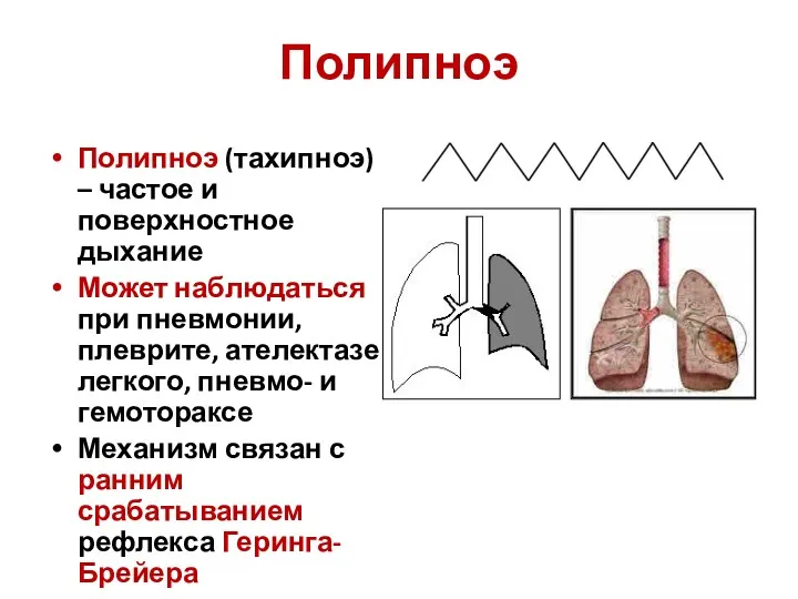 Полипноэ Полипноэ (тахипноэ) – частое и поверхностное дыхание Может наблюдаться