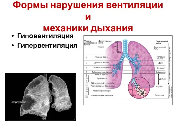 Формы нарушения вентиляции и механики дыхания Гиповентиляция Гипервентиляция