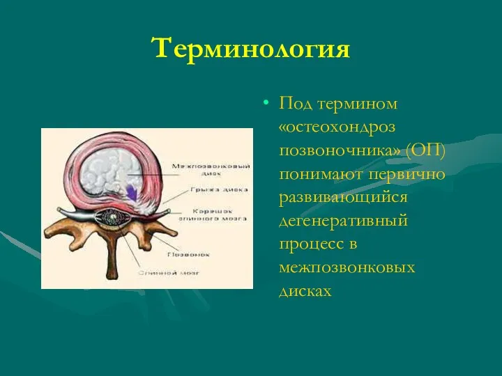 Терминология Под термином «остеохондроз позвоночника» (ОП) понимают первично развивающийся дегенеративный процесс в межпозвонковых дисках