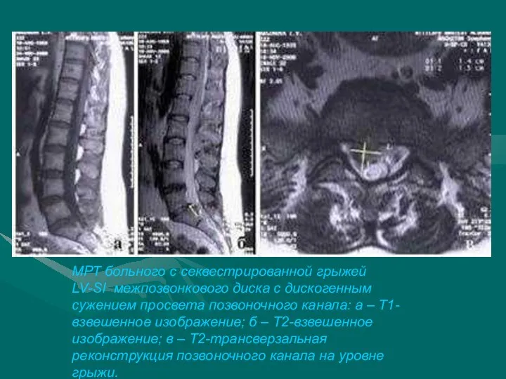 Грыжи диска МРТ больного с секвестрированной грыжей LV-SI межпозвонкового диска