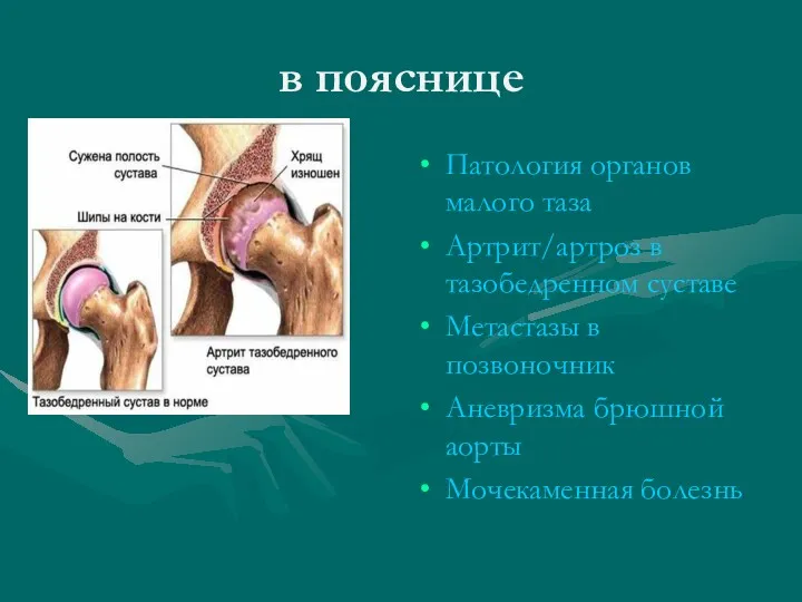 в пояснице Патология органов малого таза Артрит/артроз в тазобедренном суставе