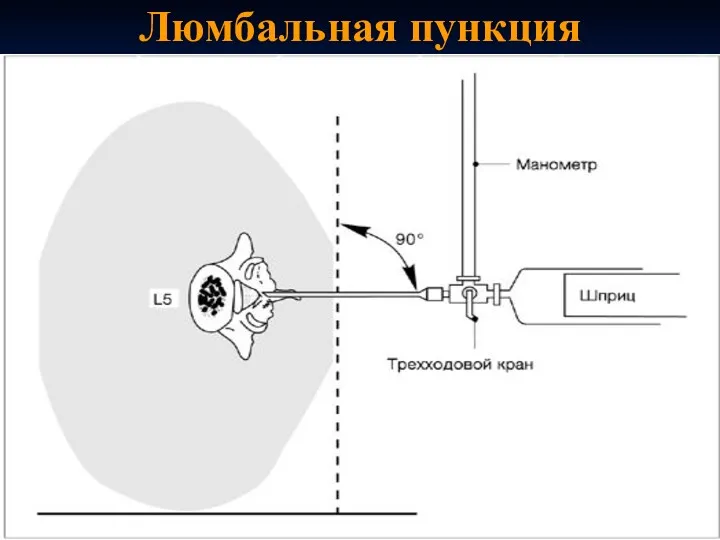 Люмбальная пункция