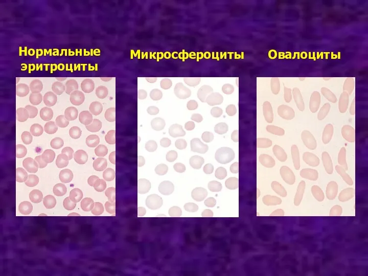 Нормальные эритроциты Микросфероциты Овалоциты