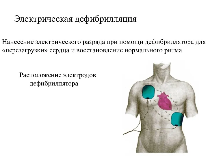 Электрическая дефибрилляция Нанесение электрического разряда при помощи дефибриллятора для «перезагрузки» сердца и восстановление