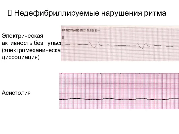 Недефибриллируемые нарушения ритма Электрическая активность без пульса (электромеханическая диссоциация) Асистолия