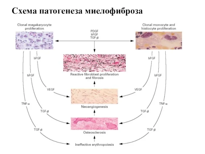 Схема патогенеза миелофиброза