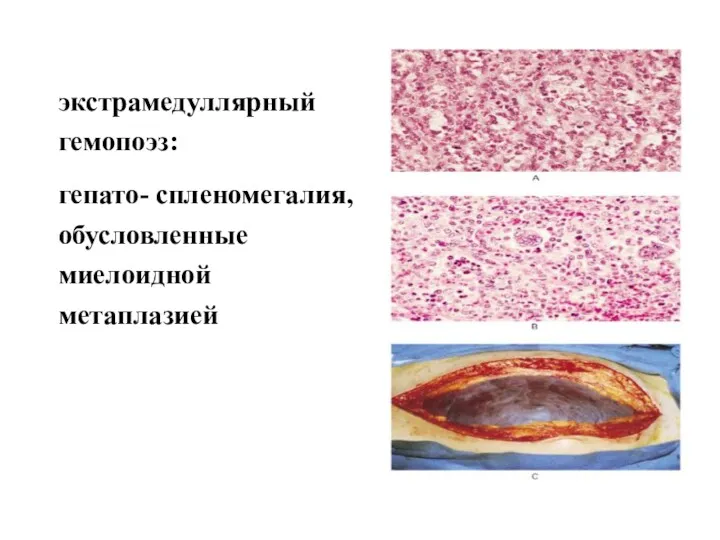 экстрамедуллярный гемопоэз: гепато- спленомегалия, обусловленные миелоидной метаплазией