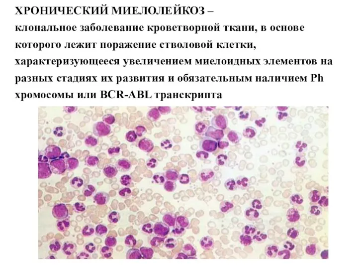 ХРОНИЧЕСКИЙ МИЕЛОЛЕЙКОЗ – клональное заболевание кроветворной ткани, в основе которого