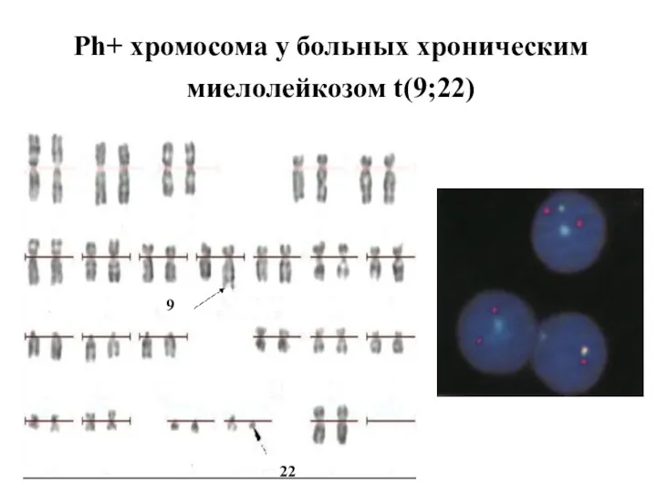 Ph+ хромосома у больных хроническим миелолейкозом t(9;22) 22 9