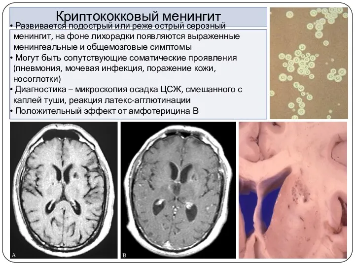 Криптококковый менингит Развивается подострый или реже острый серозный менингит, на