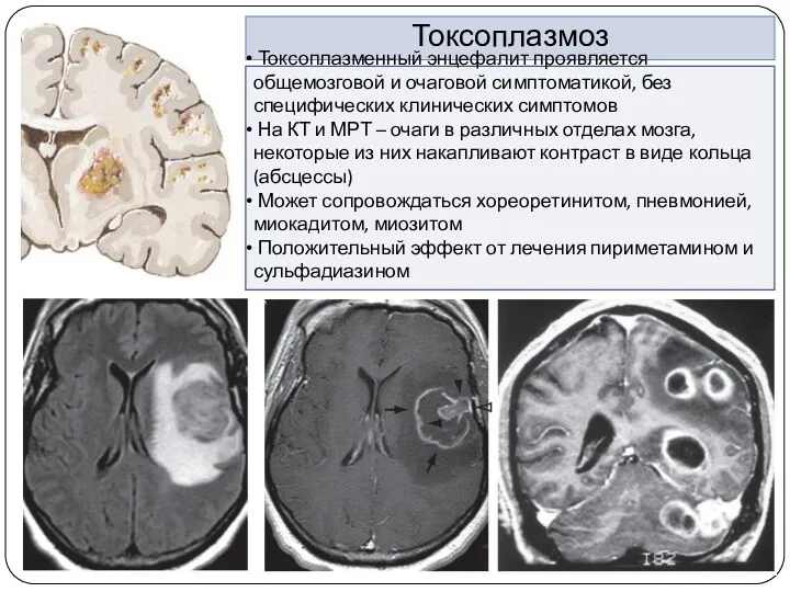 Токсоплазмоз Токсоплазменный энцефалит проявляется общемозговой и очаговой симптоматикой, без специфических