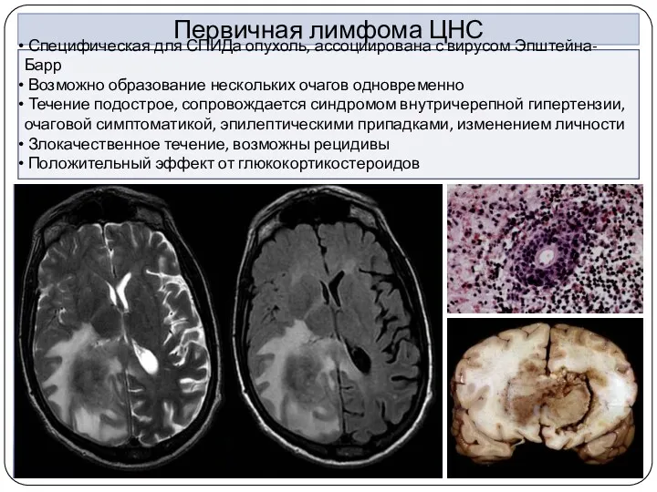 Первичная лимфома ЦНС Специфическая для СПИДа опухоль, ассоциирована с вирусом