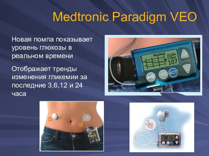 Medtronic Paradigm VEO Новая помпа показывает уровень глюкозы в реальном