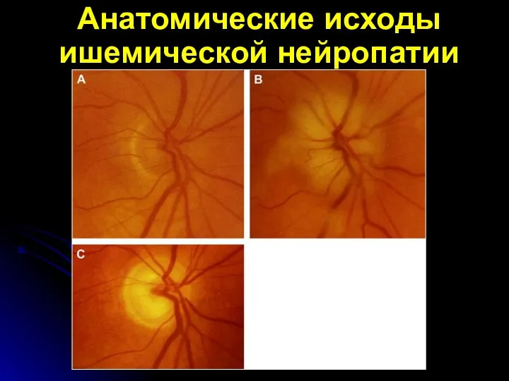 Анатомические исходы ишемической нейропатии