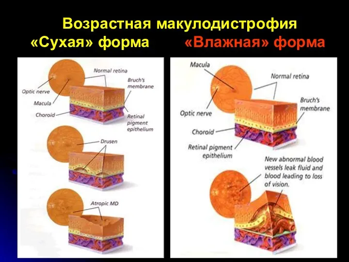 Возрастная макулодистрофия «Сухая» форма «Влажная» форма