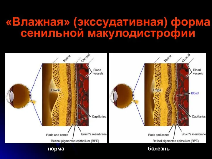 «Влажная» (экссудативная) форма сенильной макулодистрофии