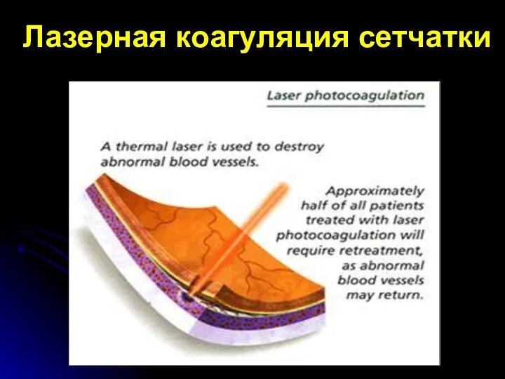 Лазерная коагуляция сетчатки