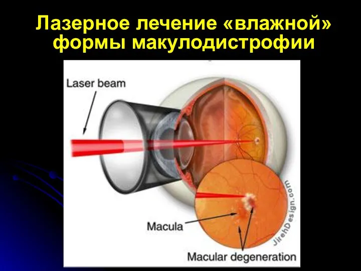 Лазерное лечение «влажной» формы макулодистрофии