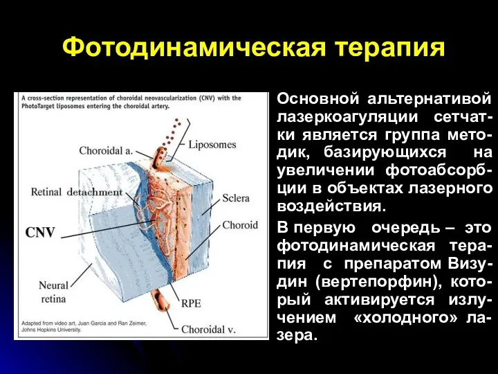 Фотодинамическая терапия Основной альтернативой лазеркоагуляции сетчат-ки является группа мето-дик, базирующихся