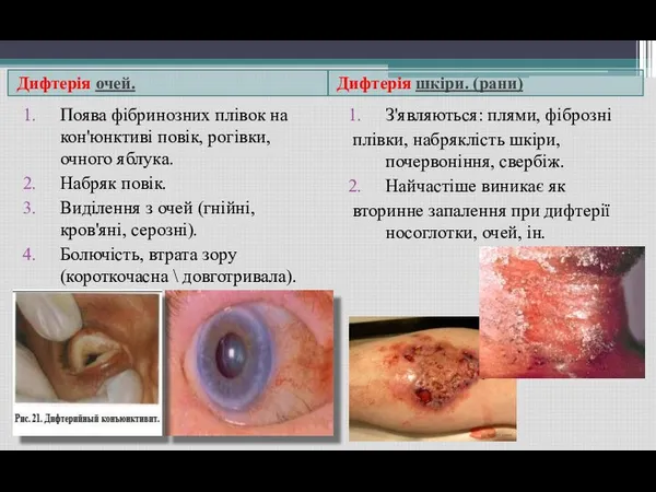 Дифтерія очей. Дифтерія шкіри. (рани) Поява фібринозних плівок на кон'юнктиві
