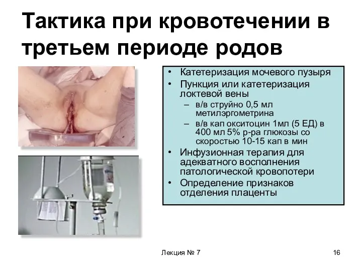 Лекция № 7 Тактика при кровотечении в третьем периоде родов Катетеризация мочевого пузыря