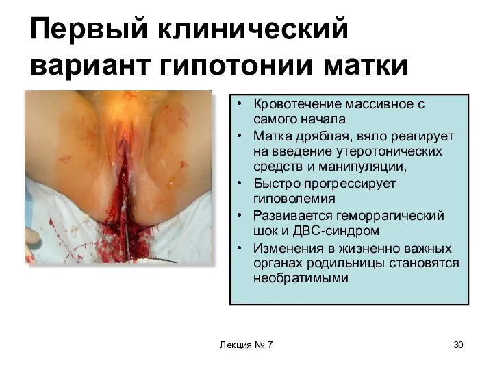 Лекция № 7 Первый клинический вариант гипотонии матки Кровотечение массивное