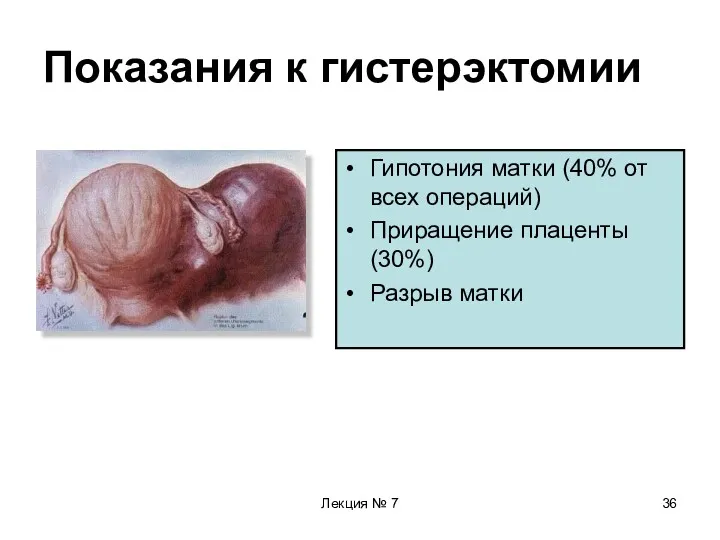 Лекция № 7 Показания к гистерэктомии Гипотония матки (40% от