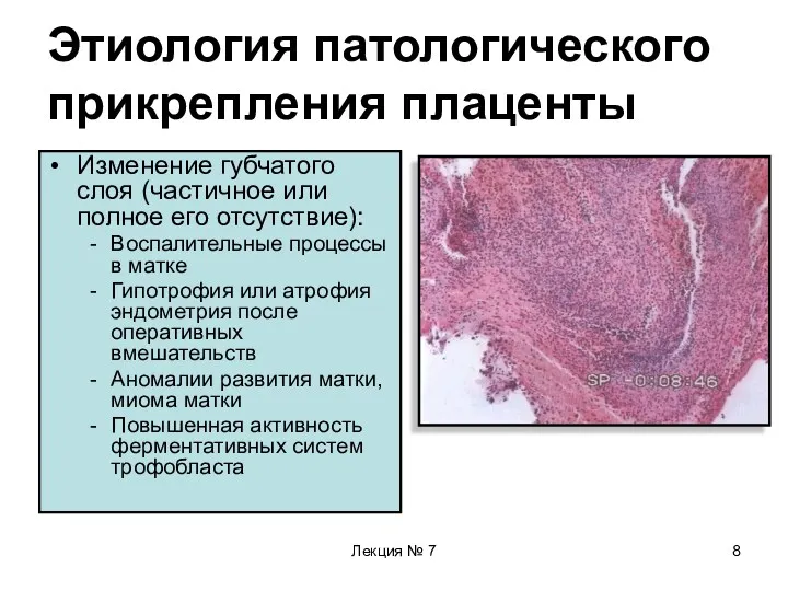 Лекция № 7 Этиология патологического прикрепления плаценты Изменение губчатого слоя (частичное или полное