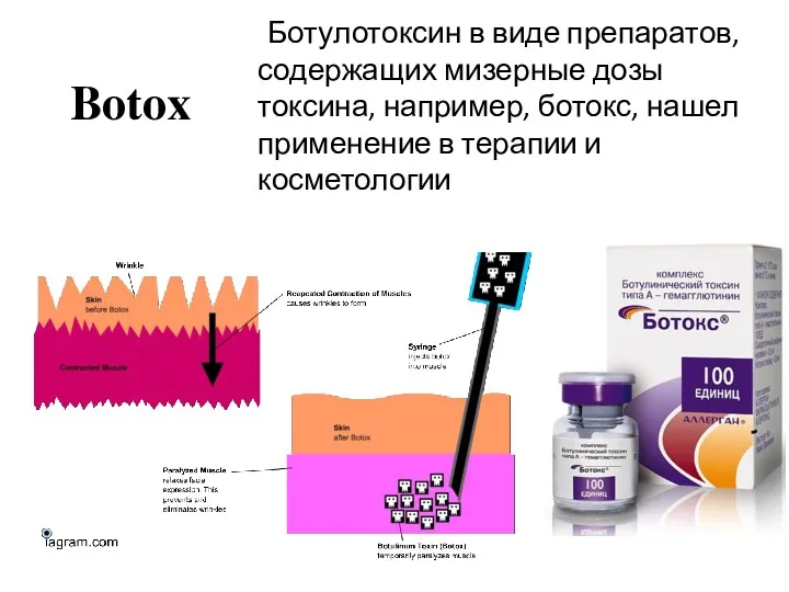 Botox Ботулотоксин в виде препаратов, содержащих мизерные дозы токсина, например,