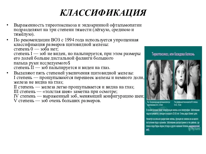 КЛАССИФИКАЦИЯ Выраженность тиреотоксикоза и эндокринной офтальмопатии подразделяют на три степени