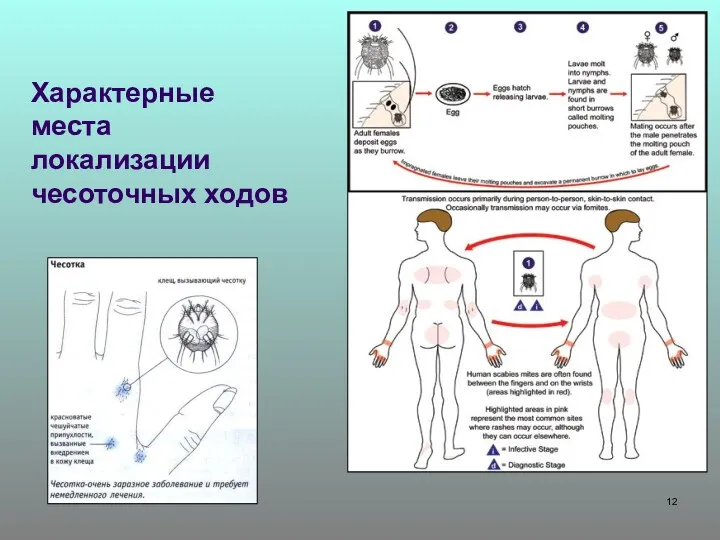 Характерные места локализации чесоточных ходов