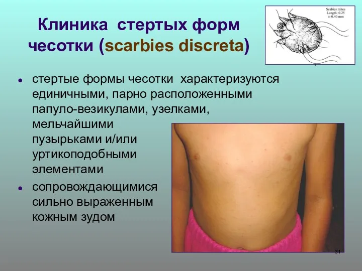 Клиника стертых форм чесотки (scarbies discreta) стертые формы чесотки характеризуются