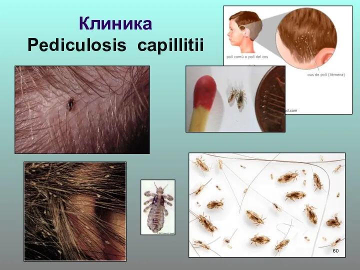 Клиника Pediculosis capillitii