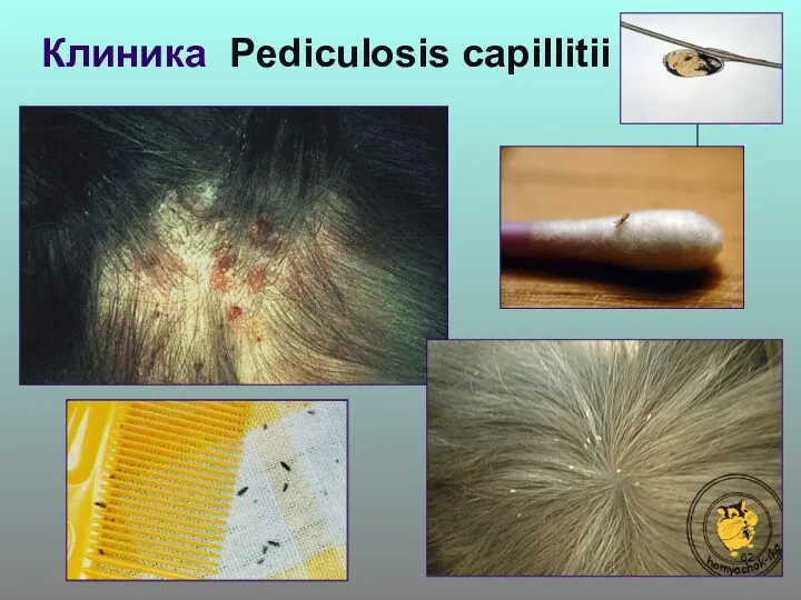 Клиника Pediculosis capillitii