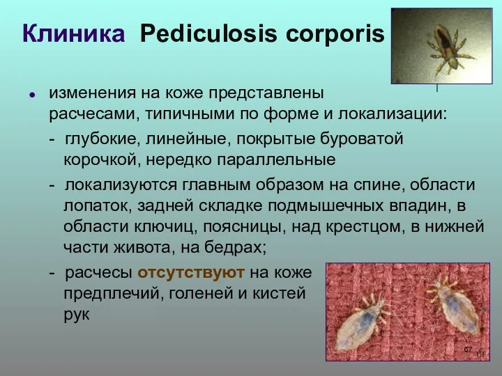 Клиника Pediculosis corporis изменения на коже представлены расчесами, типичными по