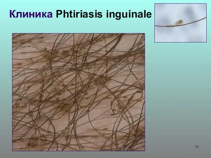 Клиника Phtiriasis inguinale