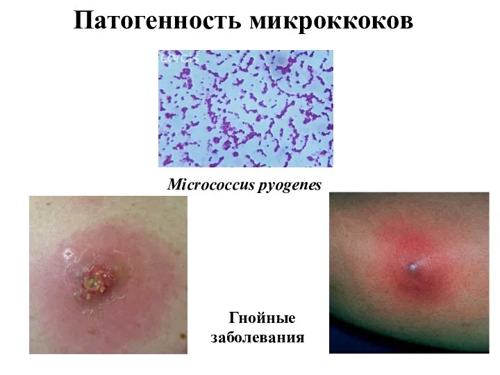 Патогенность микроккоков Micrococcus pyogenes Гнойные заболевания