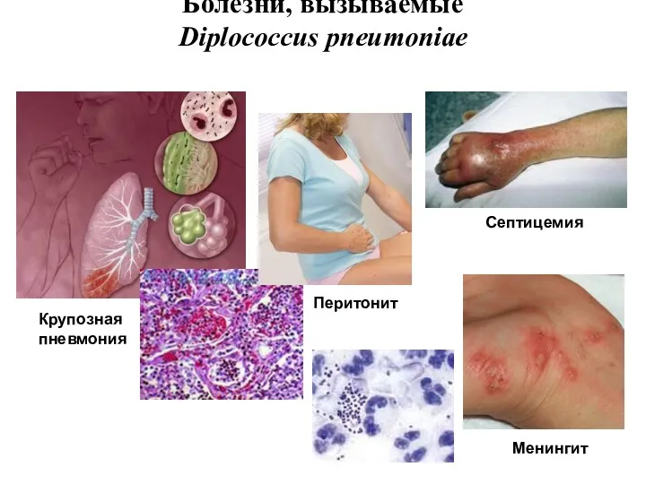 Болезни, вызываемые Diplococcus pneumoniae Септицемия Крупозная пневмония Перитонит Менингит