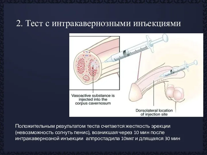 2. Тест с интракавернозными инъекциями Положительным результатом теста считается жесткость