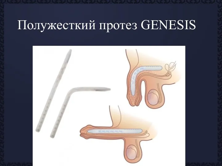 Полужесткий протез GENESIS