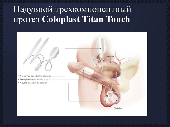 Надувной трехкомпонентный протез Coloplast Titan Touch