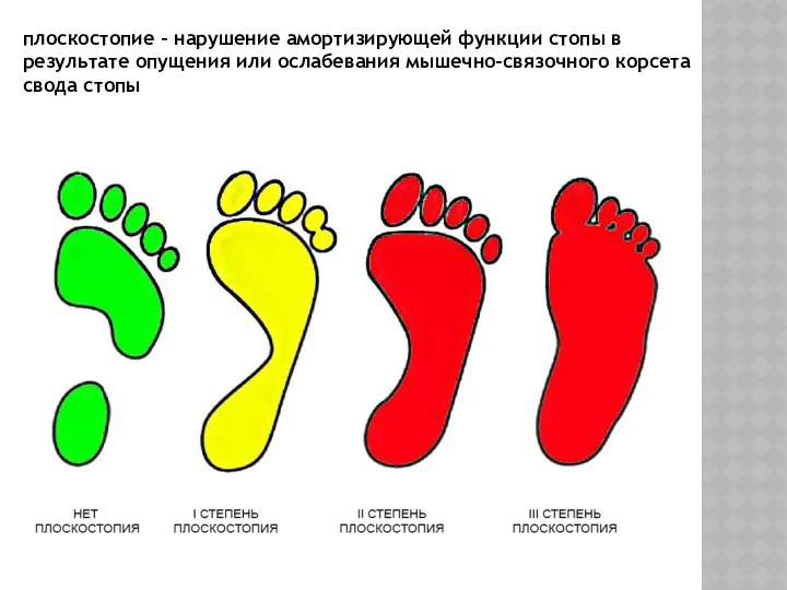 плоскостопие – нарушение амортизирующей функции стопы в результате опущения или ослабевания мышечно-связочного корсета свода стопы