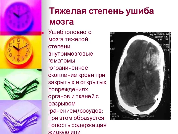 Тяжелая степень ушиба мозга Ушиб головного мозга тяжелой степени, внутримозговые