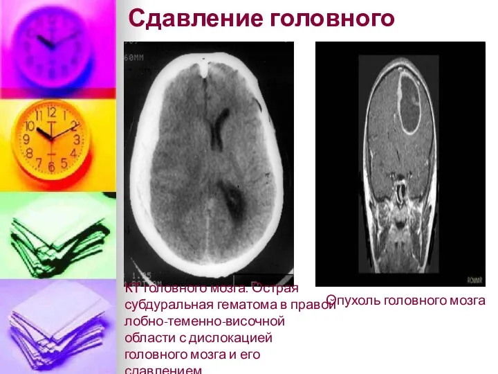 Сдавление головного мозга КТ головного мозга. Острая субдуральная гематома в