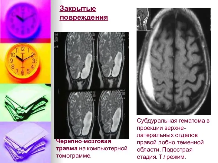 Субдуральная гематома в проекции верхне-латеральных отделов правой лобно-теменной области. Подострая