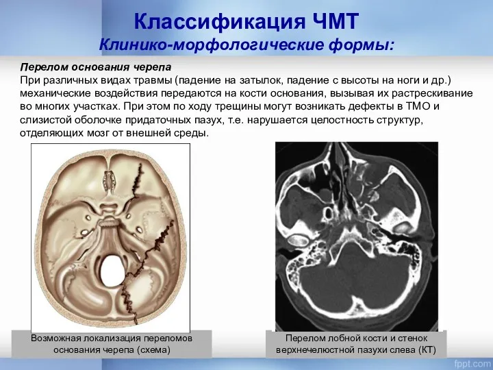 Классификация ЧМТ Клинико-морфологические формы: Возможная локализация переломов основания черепа (схема)
