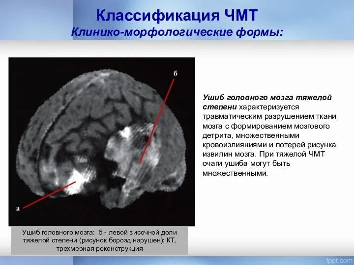 Классификация ЧМТ Клинико-морфологические формы: Ушиб головного мозга тяжелой степени характеризуется