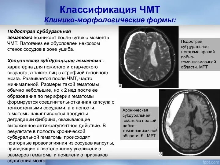 Классификация ЧМТ Клинико-морфологические формы: Подострая субдуральная гематома возникает после суток