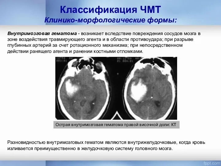 Классификация ЧМТ Клинико-морфологические формы: Внутримозговая гематома - возникает вследствие повреждения