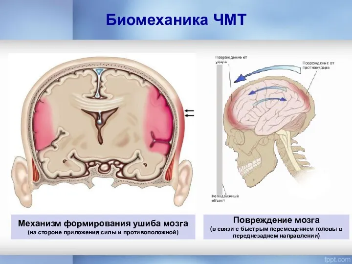 Механизм формирования ушиба мозга (на стороне приложения силы и противоположной)